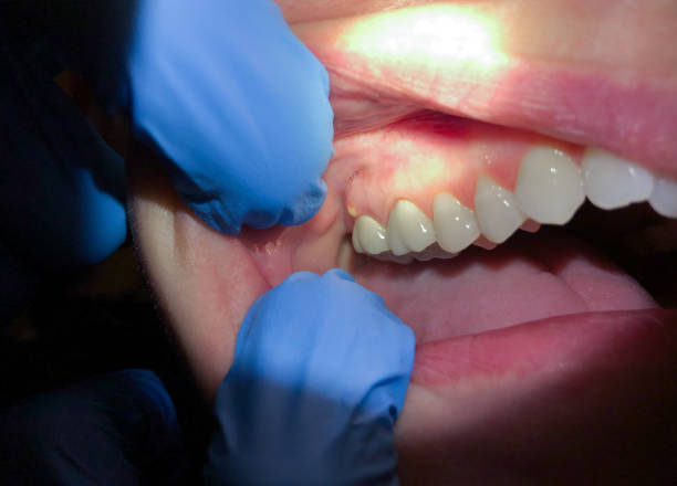 Best Emergency Dentist for Lost Fillings or Crowns in Wheaton, MD